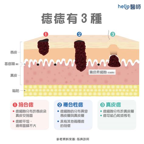 身上痣|痣形成的原因？痣長毛、痣變多變大是痣病變？5招判。